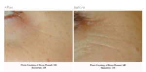 Laser Genesis Before and After laser genesis chicago