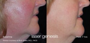Laser Genesis Before and After Rocesea 300x143