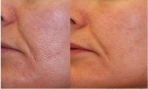 Laser Genesis before and after pore 300x181