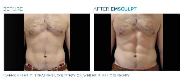 Emsculpt NEO Chicago
