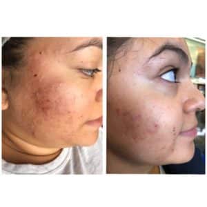microneedling donna 300x300