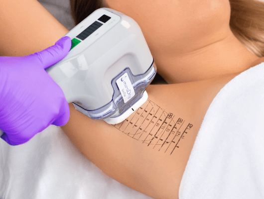 miraDry Chicago Olivo Medspa