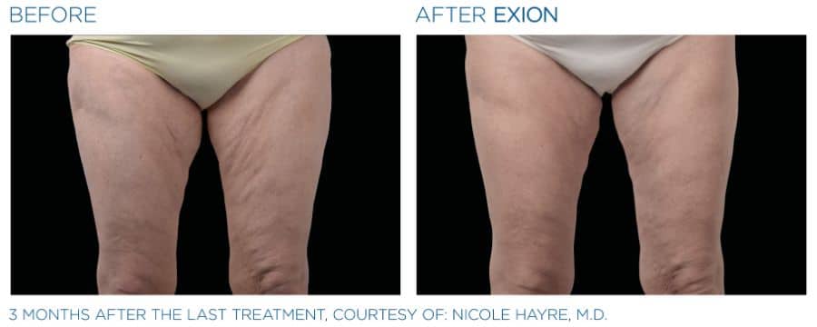 The Best Exion Chicago Provider & Spa