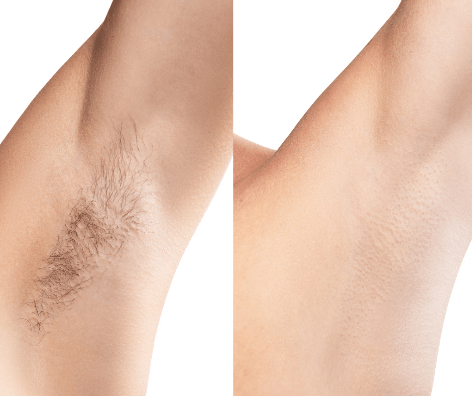 Best Armpit Hair Removal Easily Remove Underarm Hair Olivo Med Spa