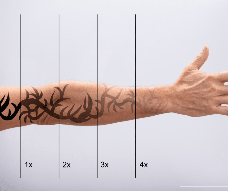 Laser Tattoo Removal Process chicago