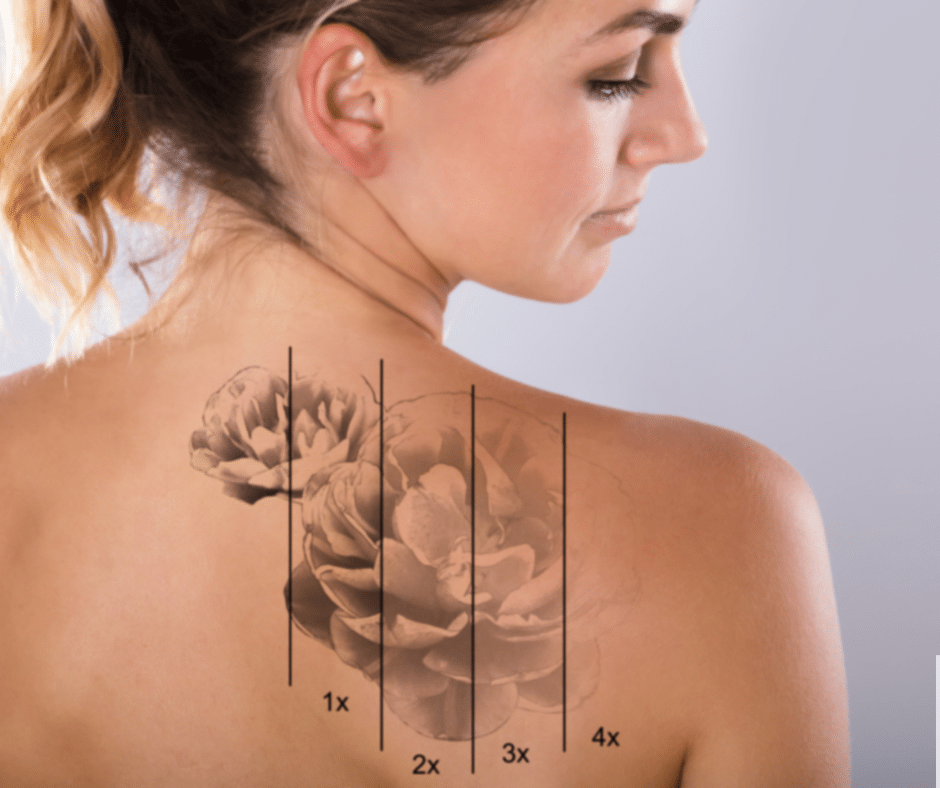 Laser Tattoo Removal Process