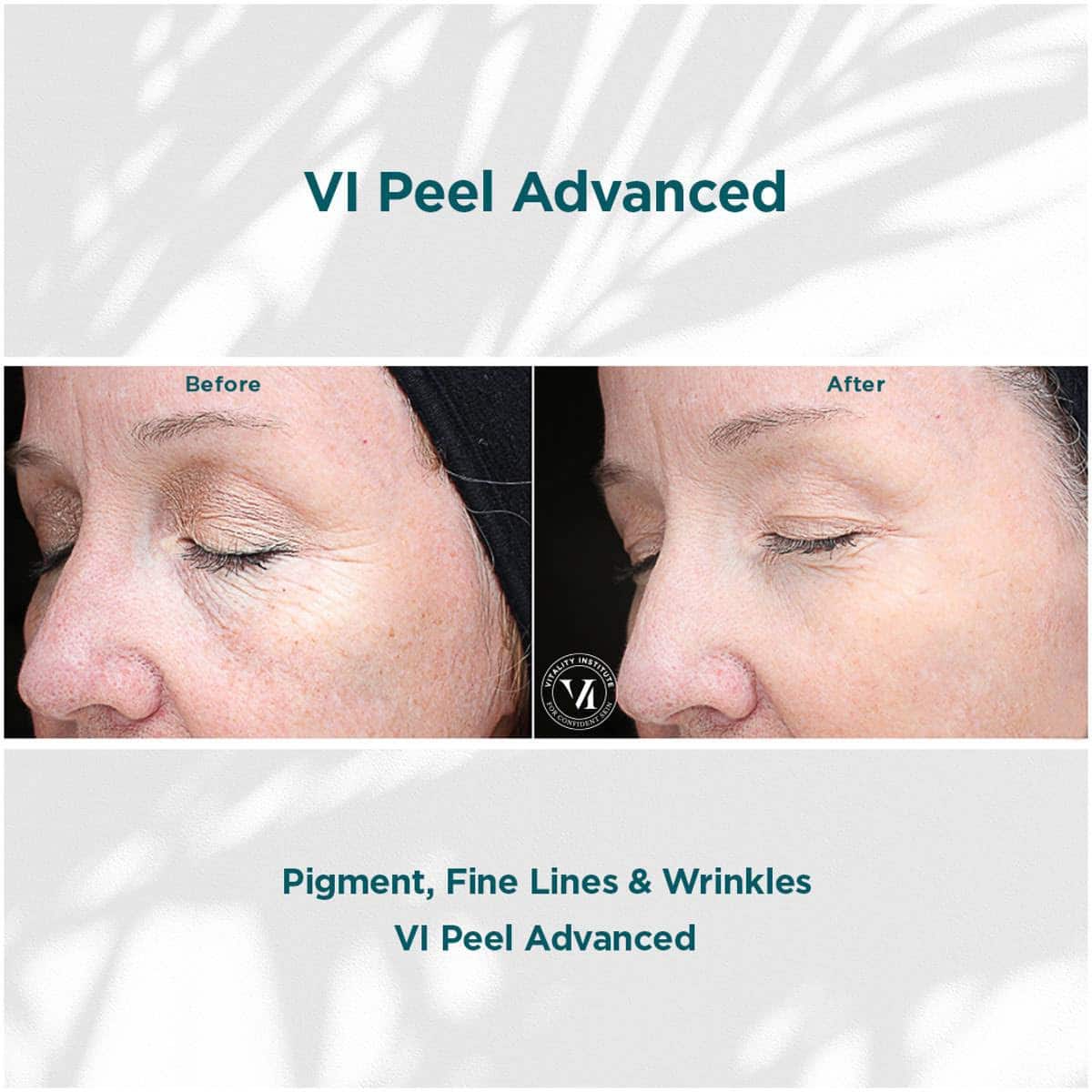 VI Peel Advanced in Chicago