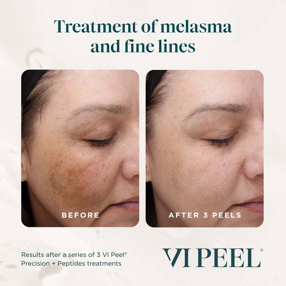 VI Chemical Peel in Chicago